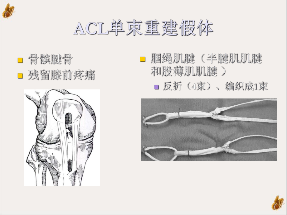 前交叉韧带(ACL)重建后：影像课件.ppt_第3页