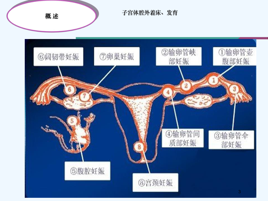 宫外孕失血性休克护理课件.ppt_第3页