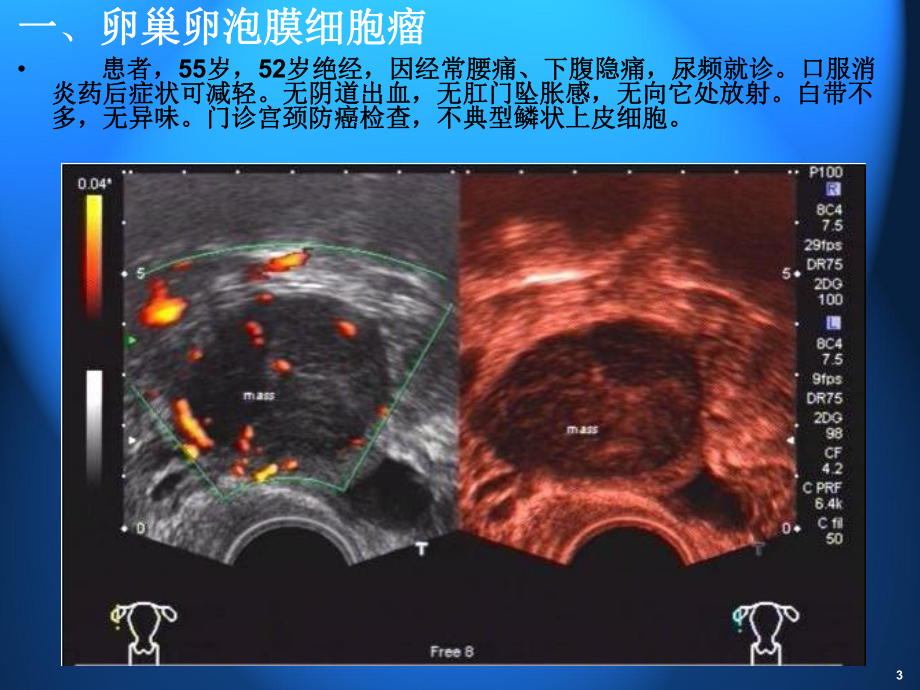 子宫畸形主题知识培训课件.ppt_第3页