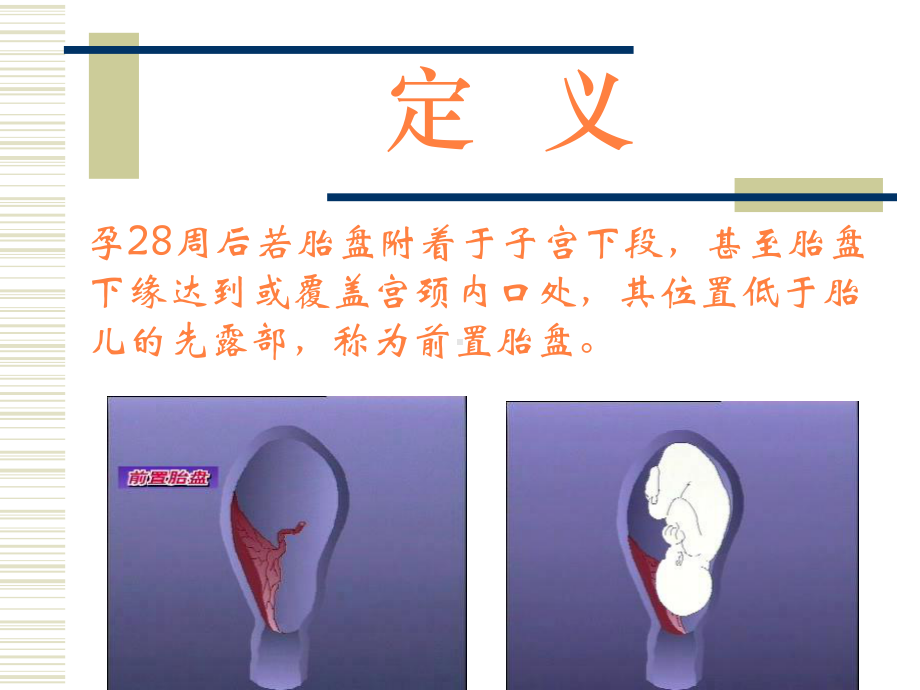 对前置胎盘病人的护理-课件.pptx_第3页