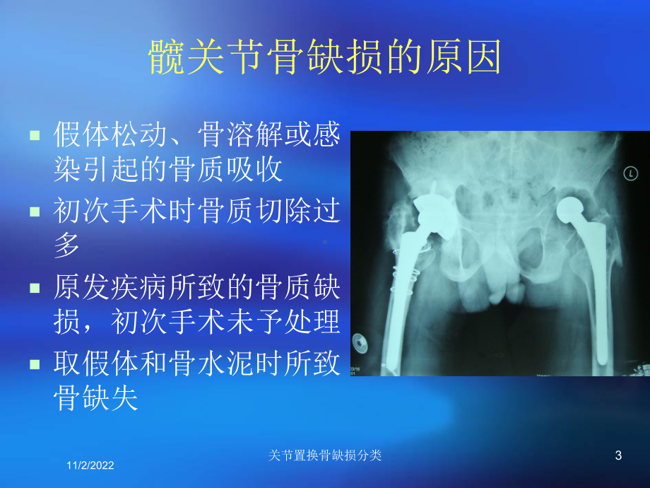 关节置换骨缺损分类课件.ppt_第3页