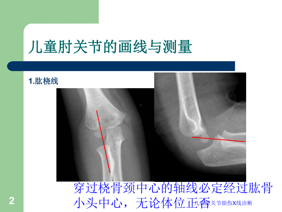 儿童肘关节损伤X线诊断培训课件.ppt_第2页