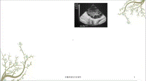 多囊卵巢综合症课件.ppt