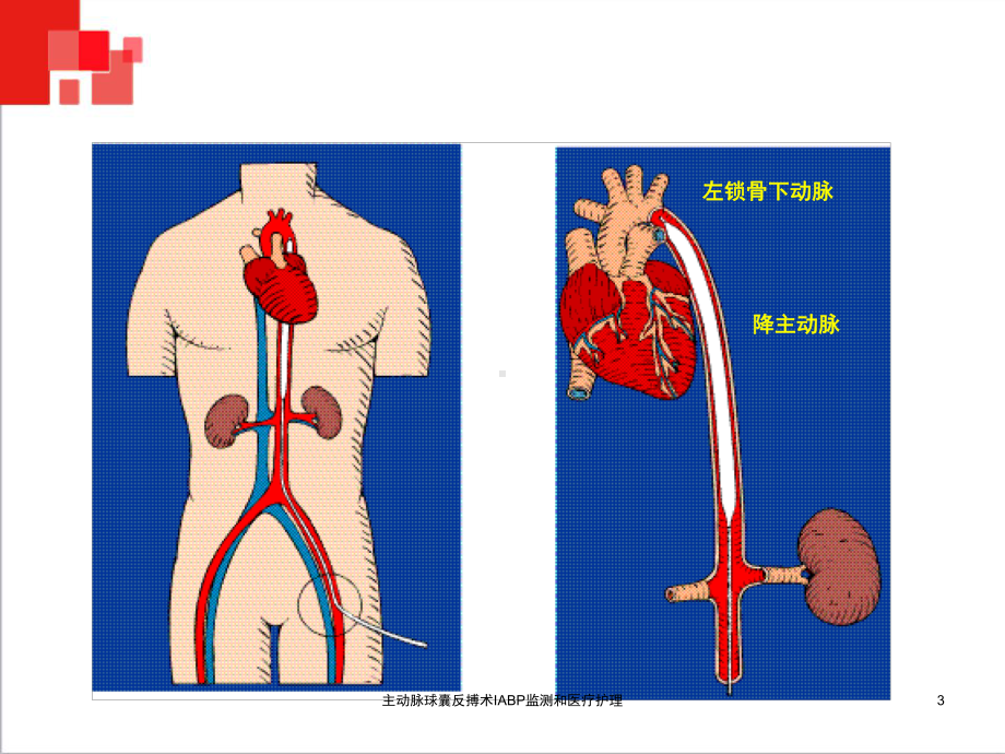 主动脉球囊反搏术IABP监测和医疗护理培训课件.ppt_第3页