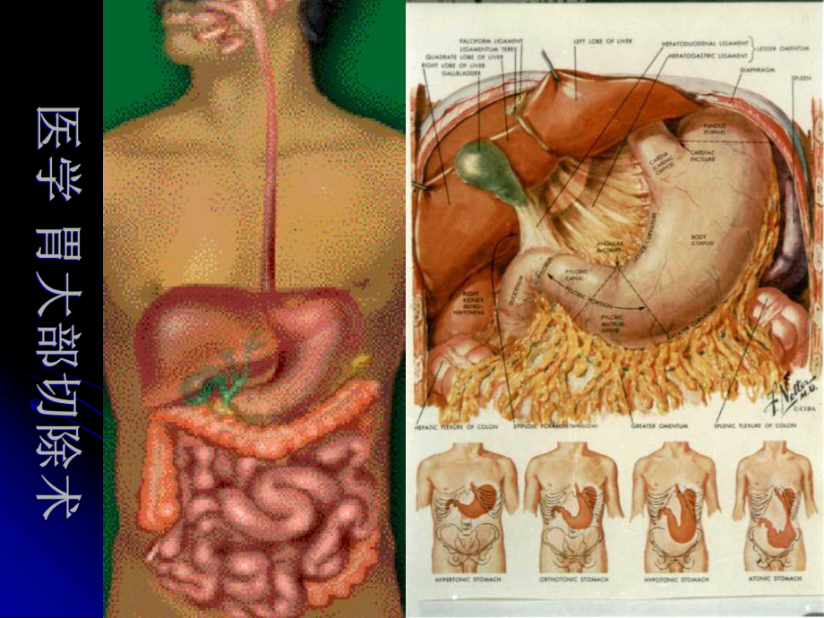 医学-胃大部切除术-课件.ppt_第3页