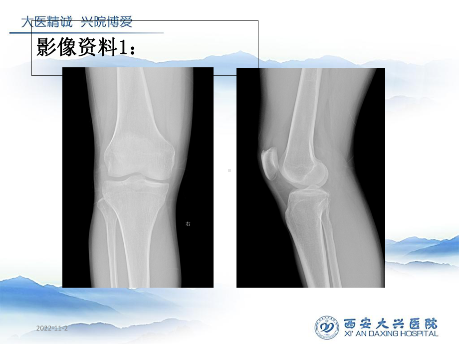 后交叉韧带胫骨止点撕脱骨折课件.ppt_第3页