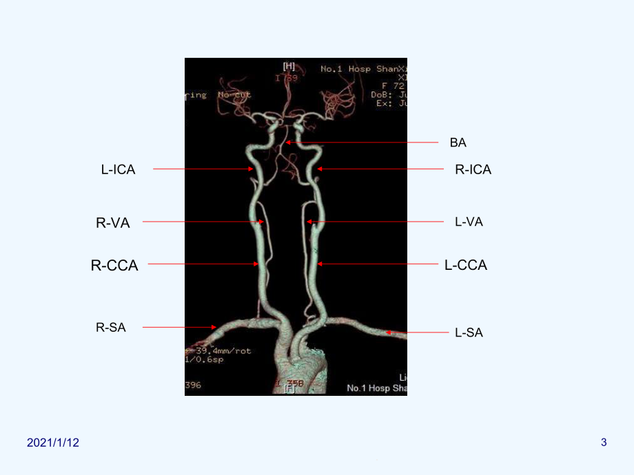 头颈部CTA及头颈部血管常见变异课件.ppt_第3页