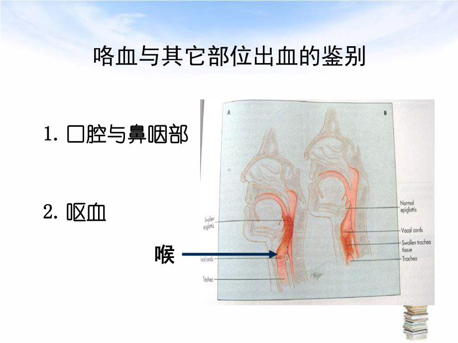 咯血的诊断与处理课件.ppt_第3页