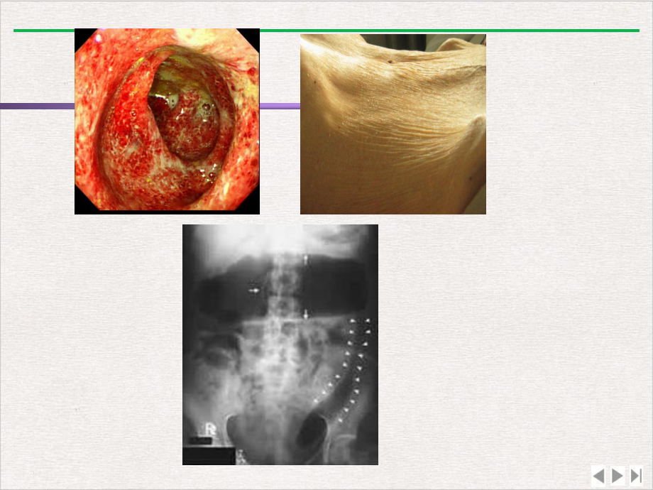 内科学炎症性肠病临床医学完美版课件.ppt_第3页