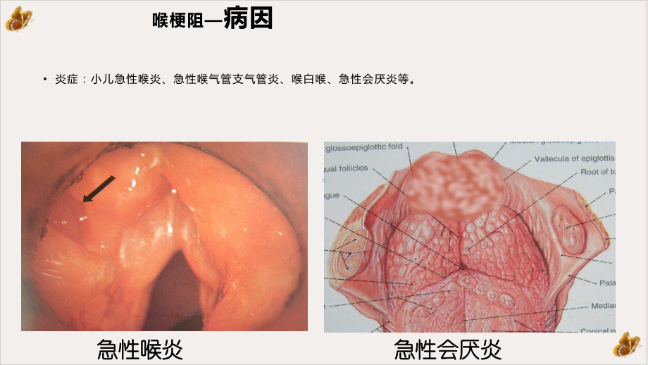 喉梗阻教学实用课件.pptx_第3页