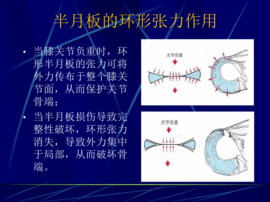 医学课件半月板损伤磁共振表现.ppt_第2页