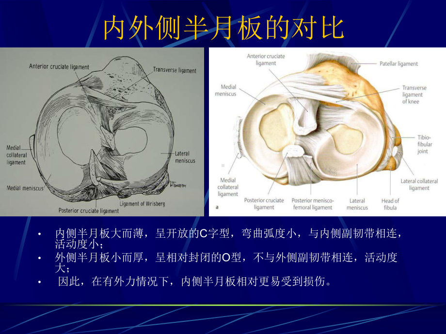 医学课件半月板损伤磁共振表现.ppt_第3页