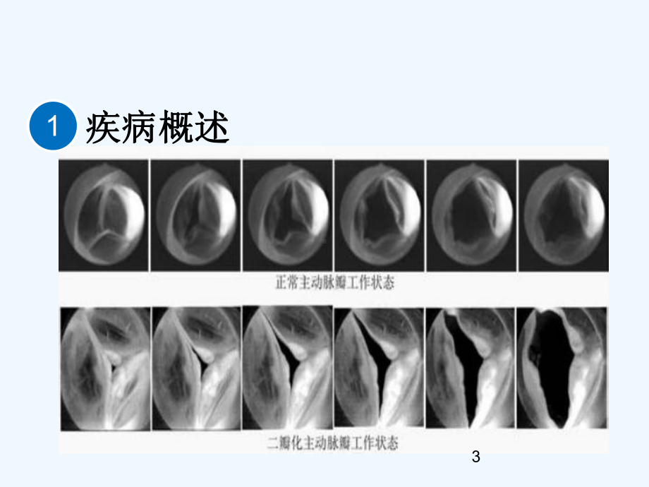 主动脉瓣二叶式畸形护理查房课件.ppt_第3页