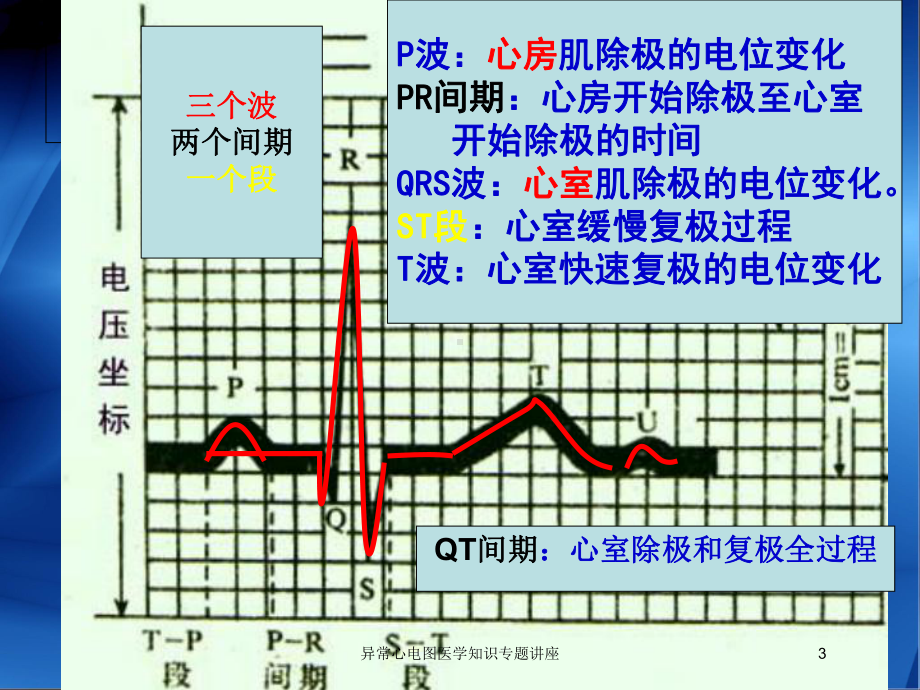 异常心电图医学知识专题讲座培训课件.ppt_第3页