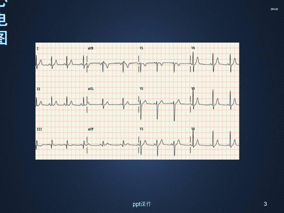 常见心电图的认识-课件.ppt_第3页