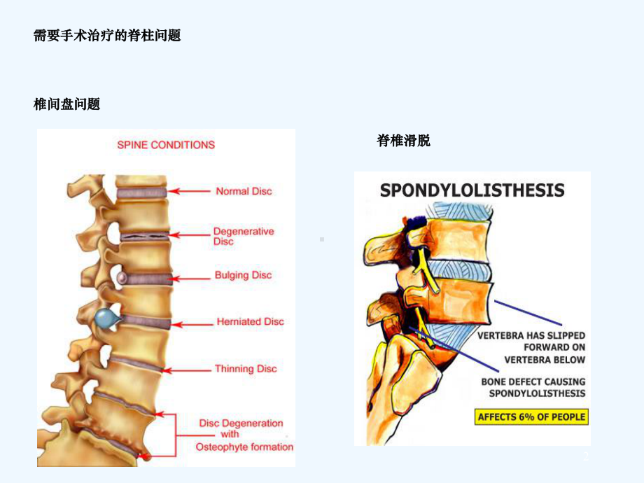 手术室护理查房脊柱手术的麻醉课件.ppt_第2页