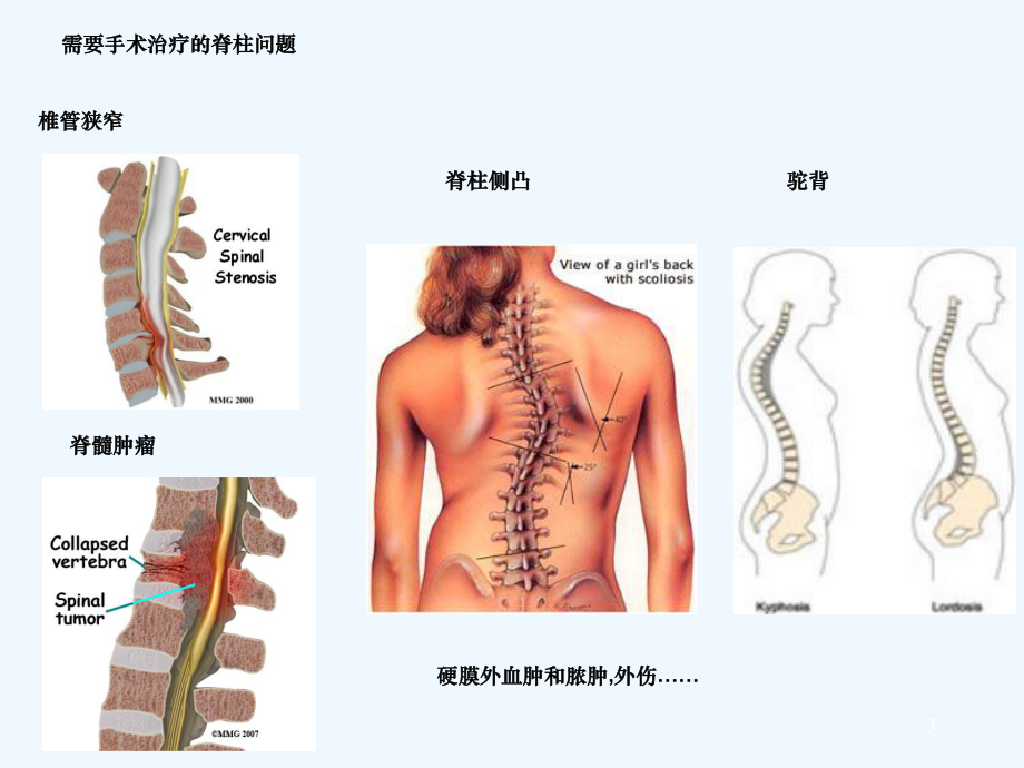 手术室护理查房脊柱手术的麻醉课件.ppt_第3页