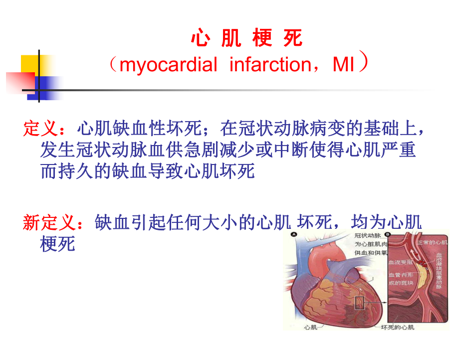 急性心肌梗死课件-3.ppt_第2页