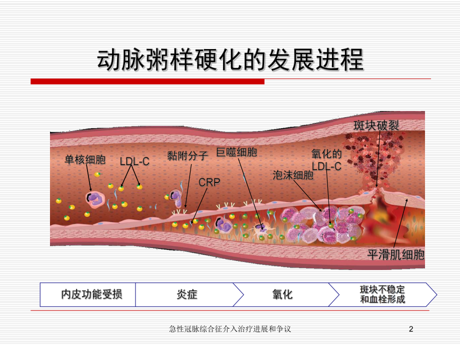 急性冠脉综合征介入治疗进展和争议培训课件.ppt_第2页