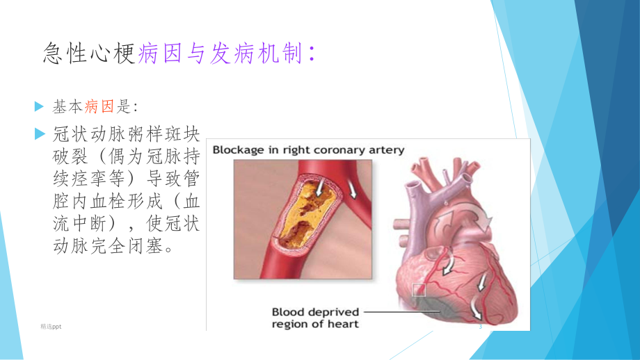 急性心梗溶栓的护理课件-2.ppt_第3页