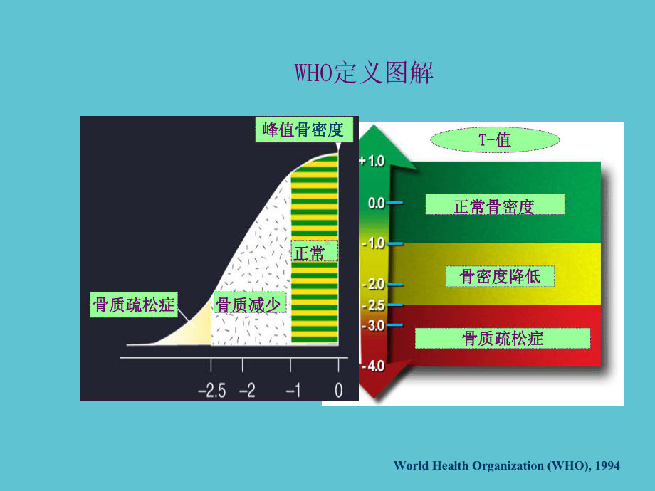 授课用-骨质疏松症及伊班膦酸钠的应用课件.ppt_第3页