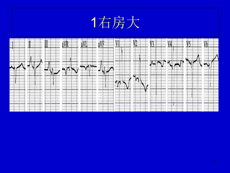 心电图典型图谱教学课件.ppt_第1页