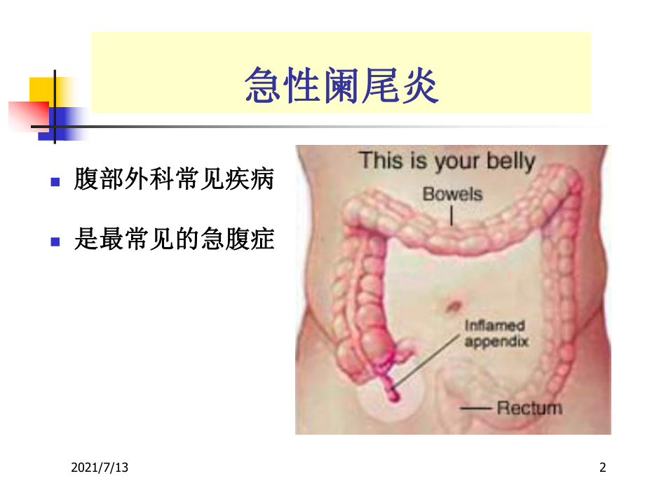 本科急性阑尾炎课件.ppt_第2页