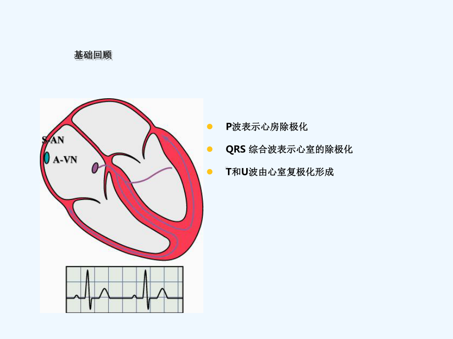 常见心脏疾病心电图表现2课件.ppt_第3页