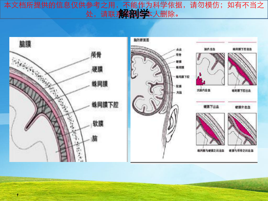 慢性硬膜下血肿培训课件.ppt_第1页