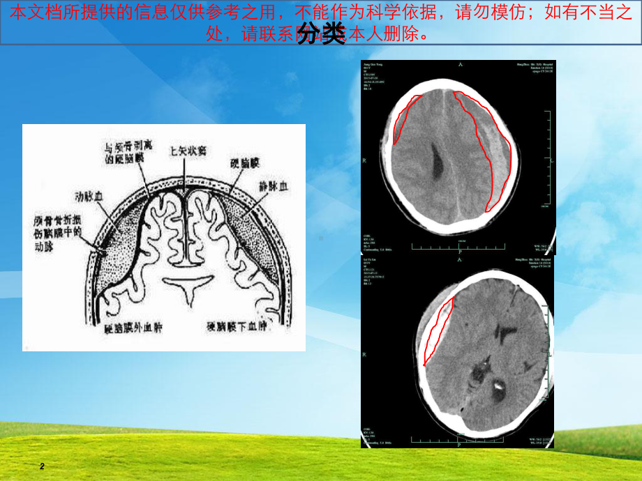 慢性硬膜下血肿培训课件.ppt_第2页