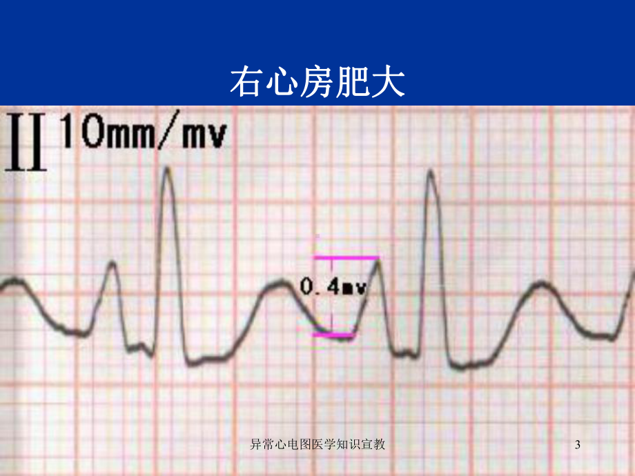 异常心电图医学知识宣教培训课件.ppt_第3页