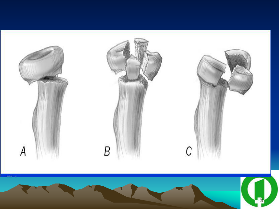 桡骨头粉碎性骨折的治疗课件.ppt_第3页