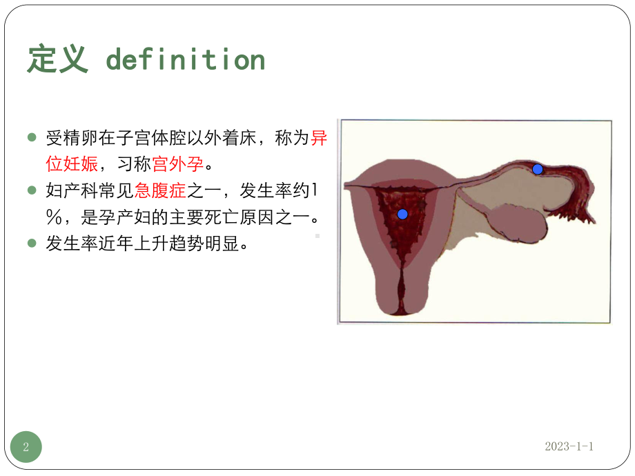 异位妊娠参考课件.ppt_第2页