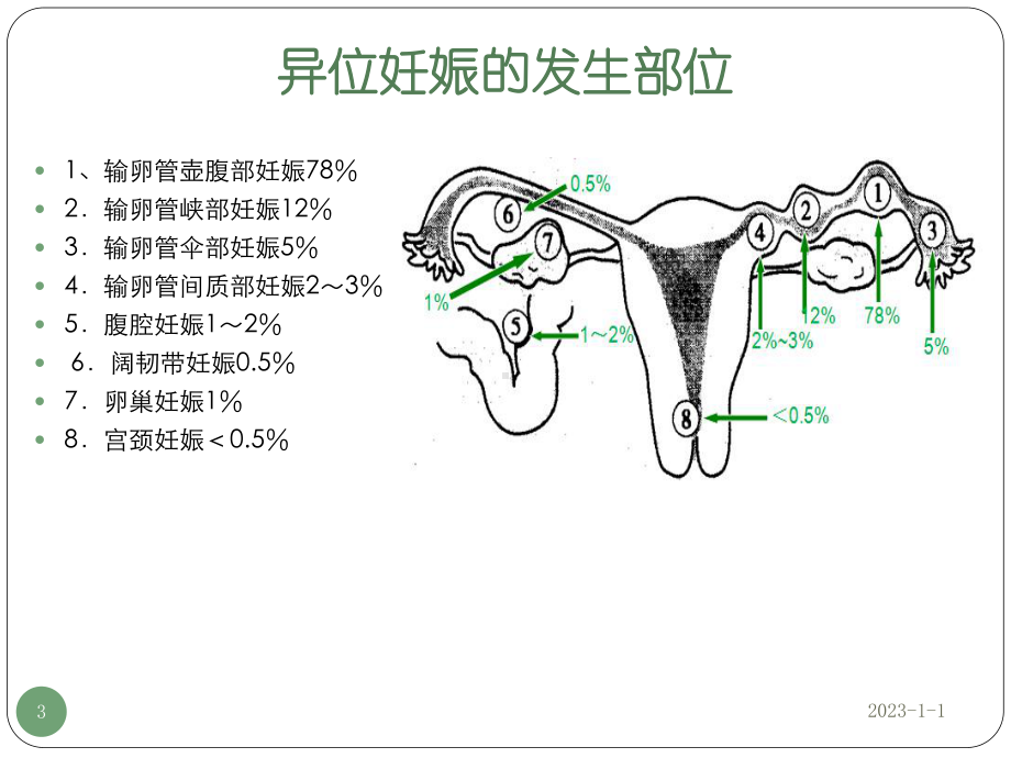 异位妊娠参考课件.ppt_第3页