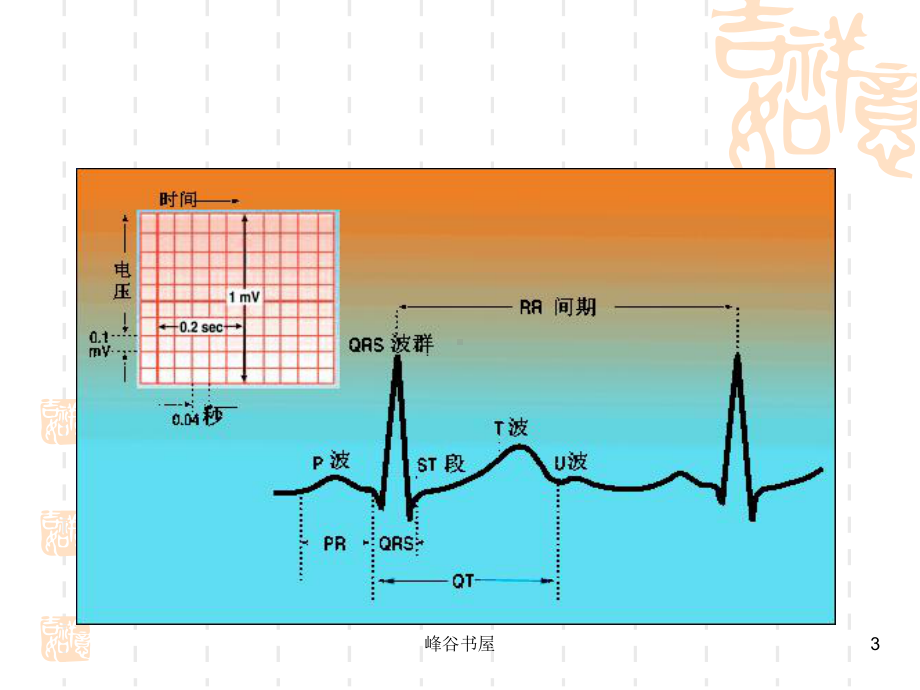 巧学常见心律失常心电图[研究材料]课件.ppt_第3页