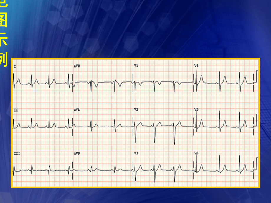 心电图基础知识含常见异常心电图培训课件.ppt_第2页
