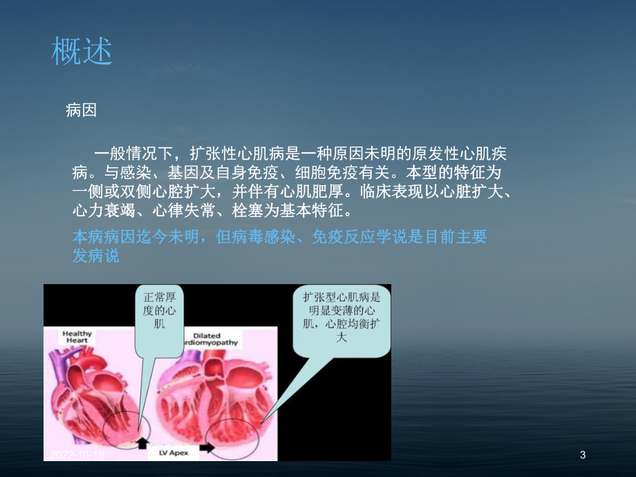 扩张型心肌病参考课件.ppt_第3页