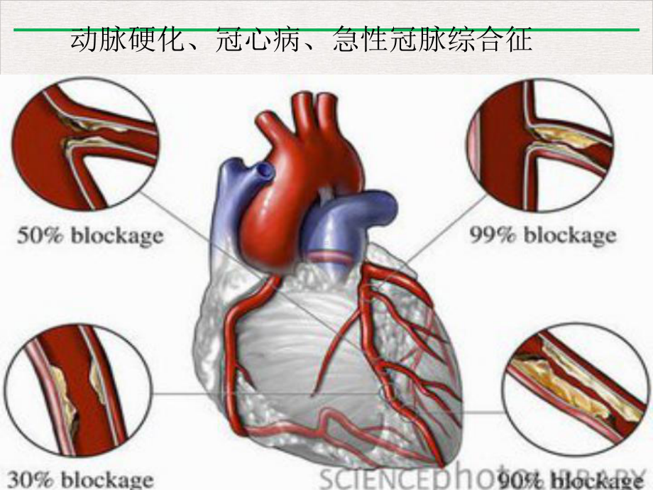 急性冠状动脉综合征实用版课件.ppt_第2页