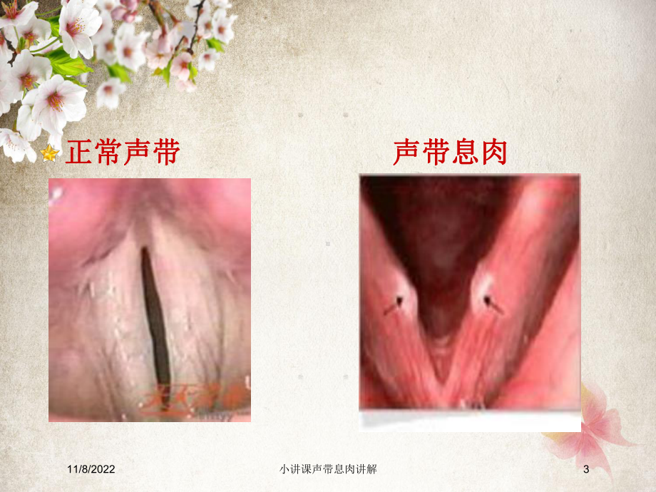 小讲课声带息肉讲解课件.ppt_第3页