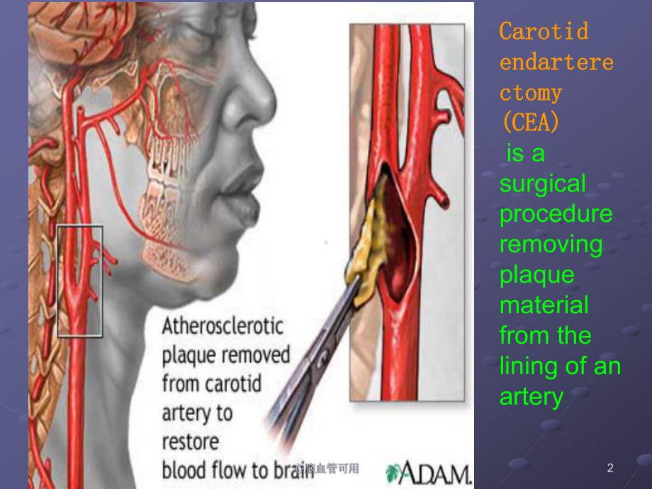 心脑血管可用课件.ppt_第2页