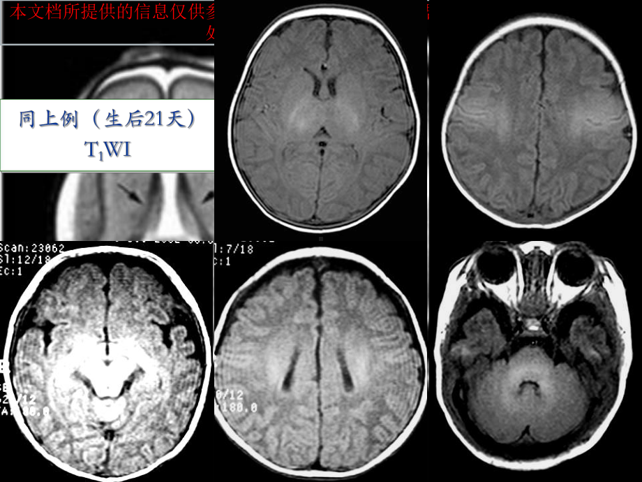 新生儿缺氧缺血或窒息所致脑损伤的影像学诊疗培训课件.ppt_第3页