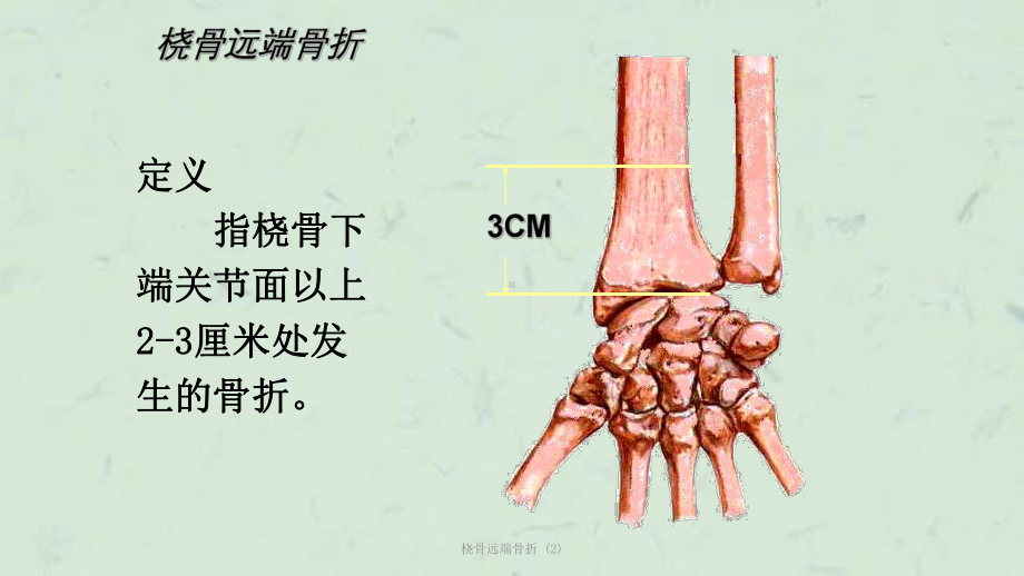 桡骨远端骨折-课件.ppt_第2页