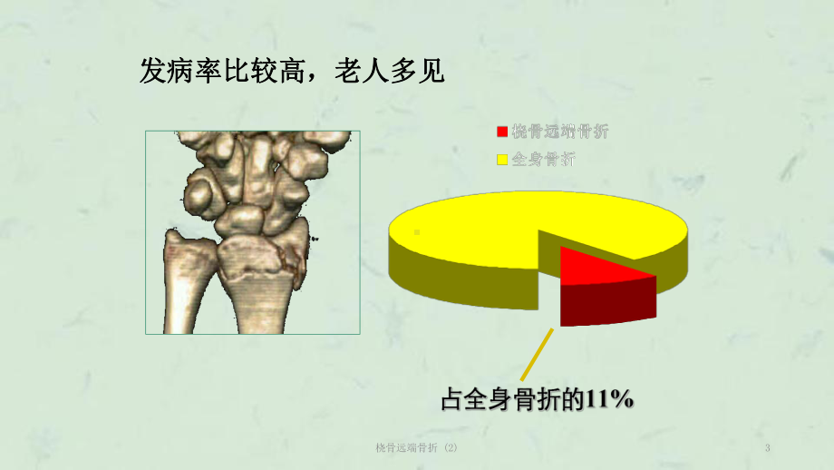 桡骨远端骨折-课件.ppt_第3页