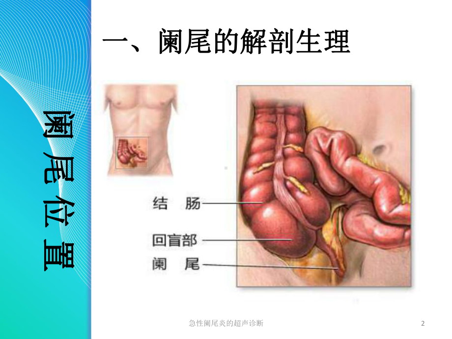 急性阑尾炎的超声诊断培训课件.ppt_第2页