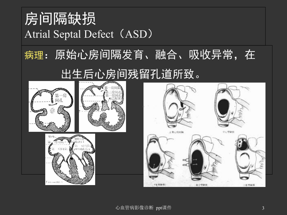 心血管病影像诊断-课件.ppt_第3页