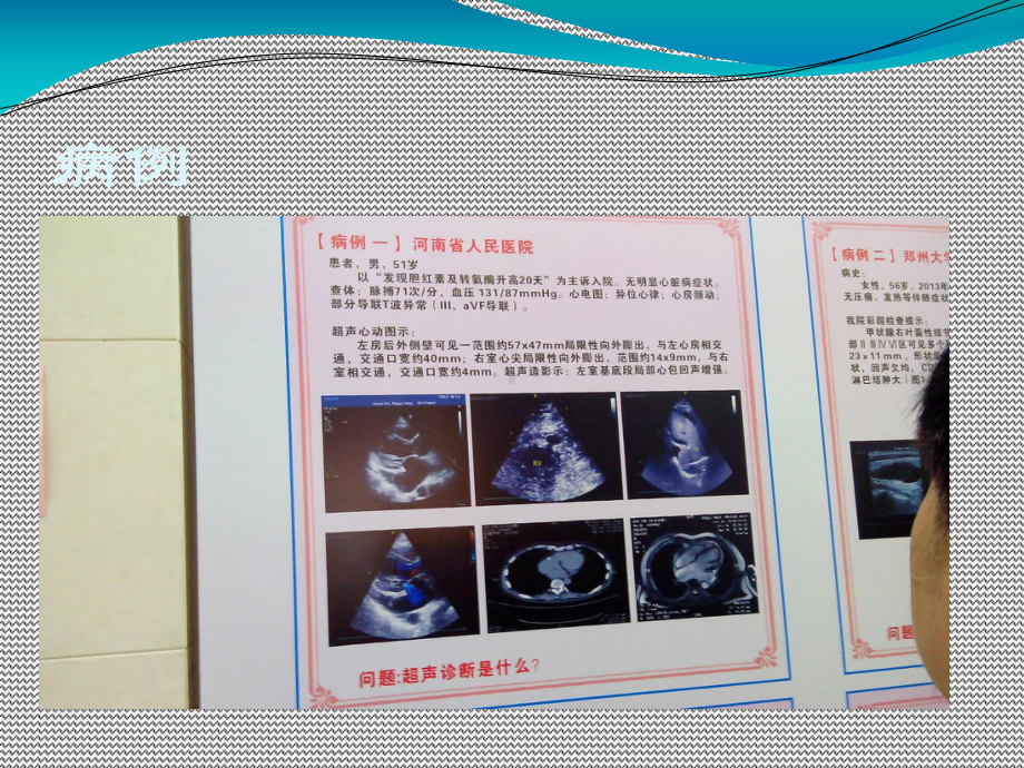 心脏憩室超声诊断课件.ppt_第2页