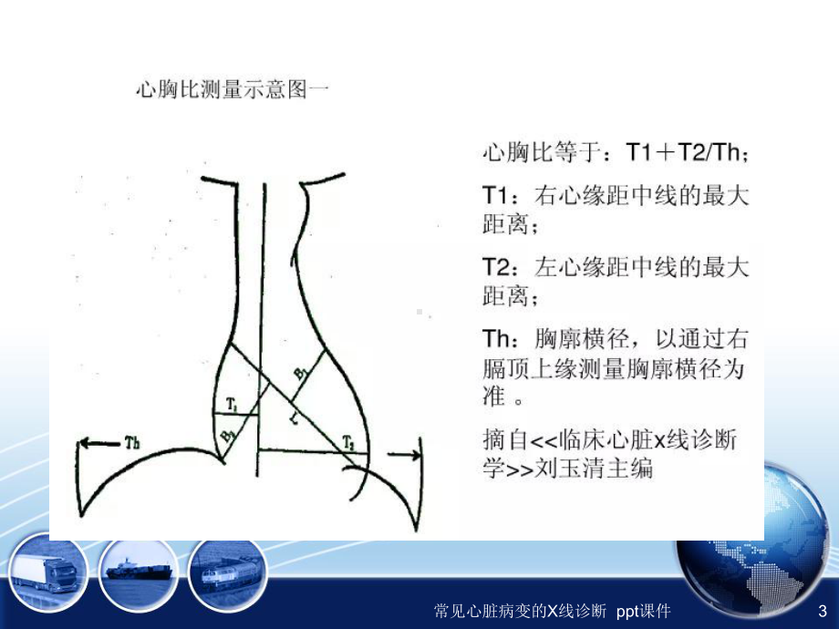 常见心脏病变的X线诊断-课件.ppt_第3页