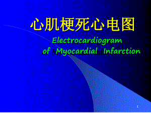 心肌梗死心电图参考课件.ppt