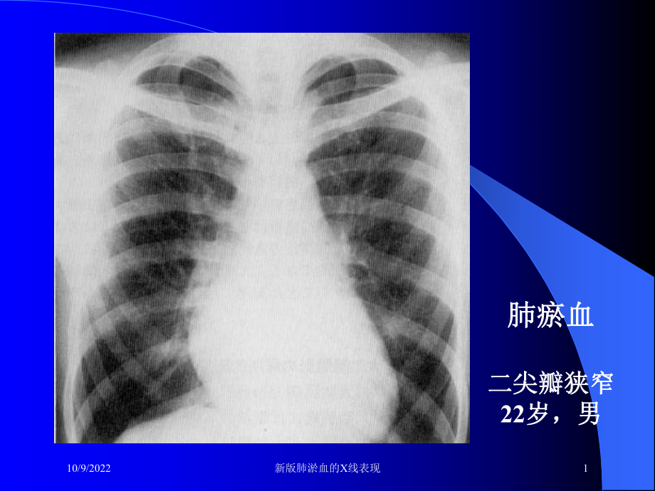 新版肺淤血的X线表现培训课件.ppt_第1页