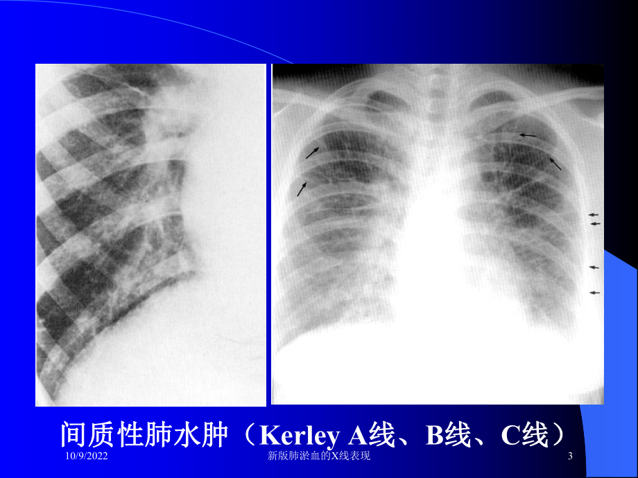 新版肺淤血的X线表现培训课件.ppt_第3页